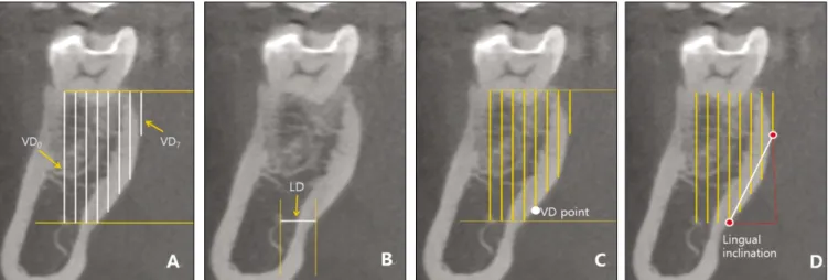 Fig. 2. Four  measurement  items  on  the  coronal  views.  A.  VD X ( X =0-7):  the  distance  between  the  top  of  the  canal  and  the alveolar  crest