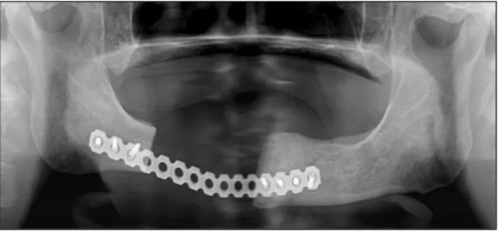 Fig. 10. The  R-plate  reconstruction  was  performed  after segmental  resection  of  the  right  posterior  mandible