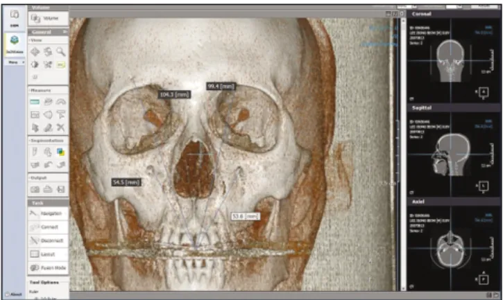 Fig. 1. Measuring  the  distance  between  4  reference  points and  contact  point  of  maxillary  central  incisors  on  a In2Vision 3-dimensional surgical navigation system.