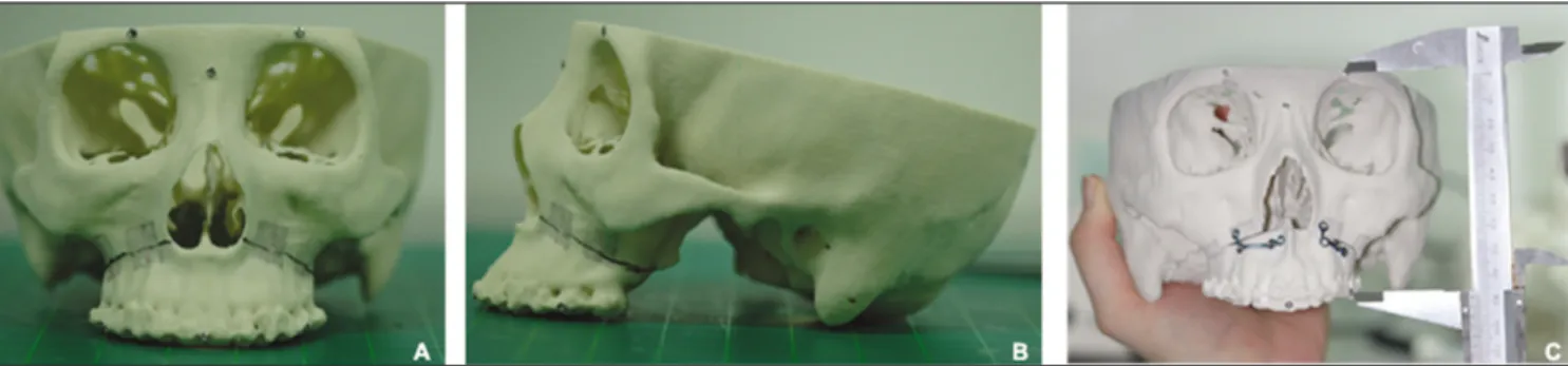 Fig. 5. Measuring  the  distance  between  4  reference  points on skull and ICP after simulation surgery on RP model  (ICP: interincisal contact point, RP: rapid prototyping)
