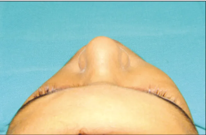 Fig. 1. Frontal  view  revealing  a  unilateral swelling of the right middle-face.