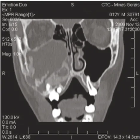 Fig. 6. Computed tomography. Axial section. Fig. 7. Computed tomography. Coronal section.