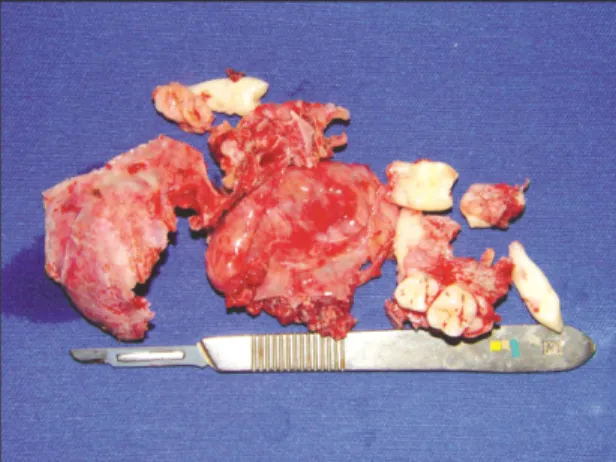 Fig. 13. Titanium  miniplates  were  placed  to  avoid complete collapse of the right cheek.