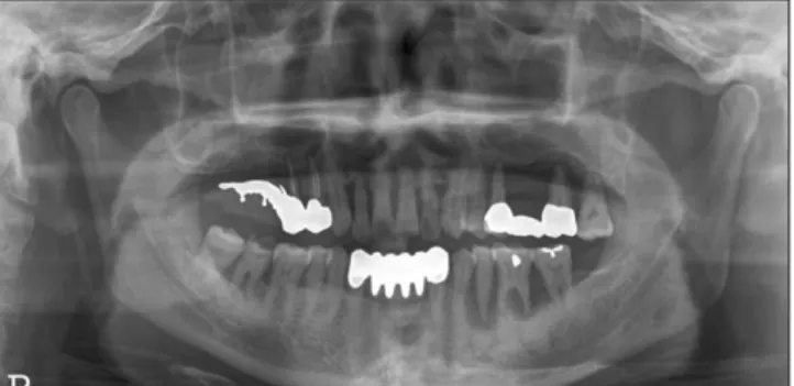 Fig. 2. Preoperative  intraoral  view.  Teeth  were  extracted  2 months ago.