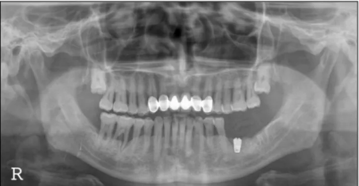 Fig. 17. Implant  was  placed  6  months  after  bone  graft.