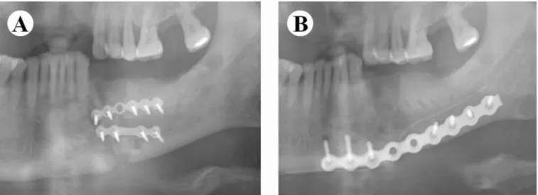 Fig. 4. Re-operation in a case of osteomyelitis. A. Panorama radiograph after 3 months, B