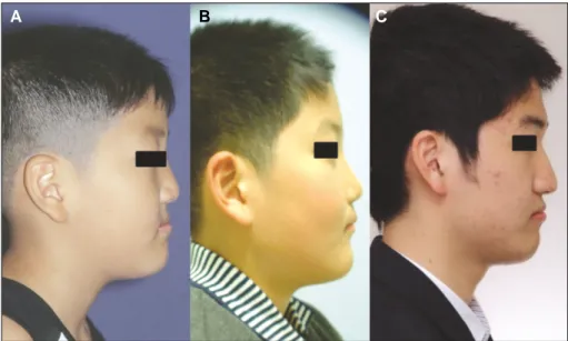 Fig. 4. Comparison  of  clinical  photo- photo-graph.  A.  Preoperative,  B.  After   dis-traction  osteogenesis,  C