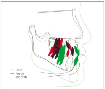 Fig. 7. Superimposition  of  Lateral  cephlogram.(T0-Black, T1-Red, T5-Green)