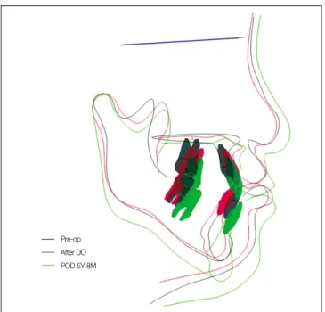 Fig. 10. Superimposition  of  Lateral  cephlogram.(T0-Black, T1-Red, T5-Green)