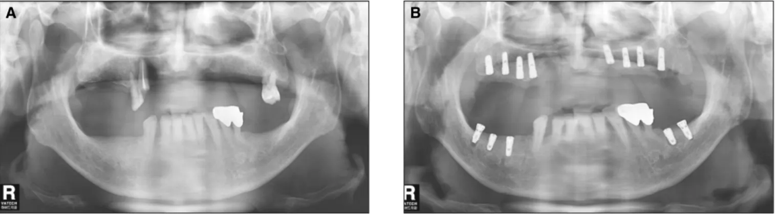 Fig. 1. A: Preoperative radiography. B: Postoperative radiography. Implants were placed on areas #36, 37, 45, 46, and 47 in the mandible