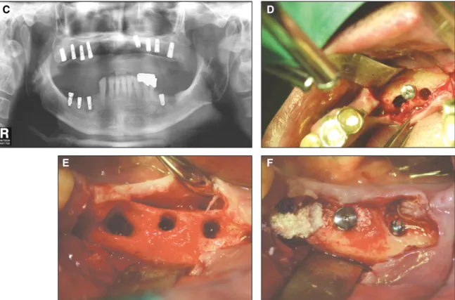 Fig. 1. C: The radiolucency around the middle portion of the #37, 45, 46, and #47 implants was noted, and was particularly remarkable  at  #37  and  #45