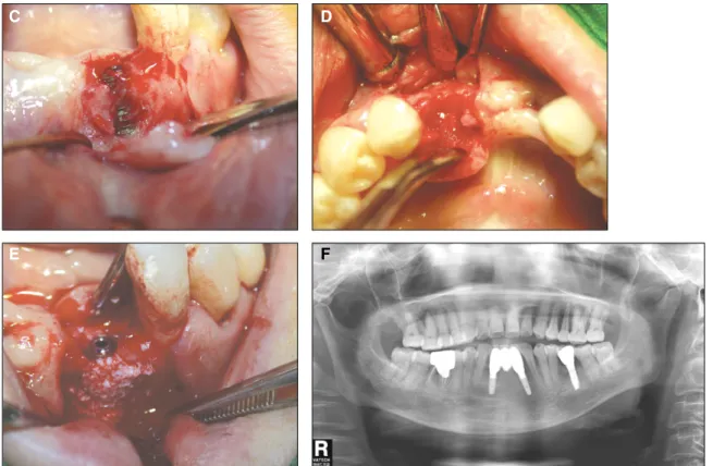 Fig. 3. C: Bony dehiscence was noted after 4 weeks. D: The implant was removed, and a bone defect was observed