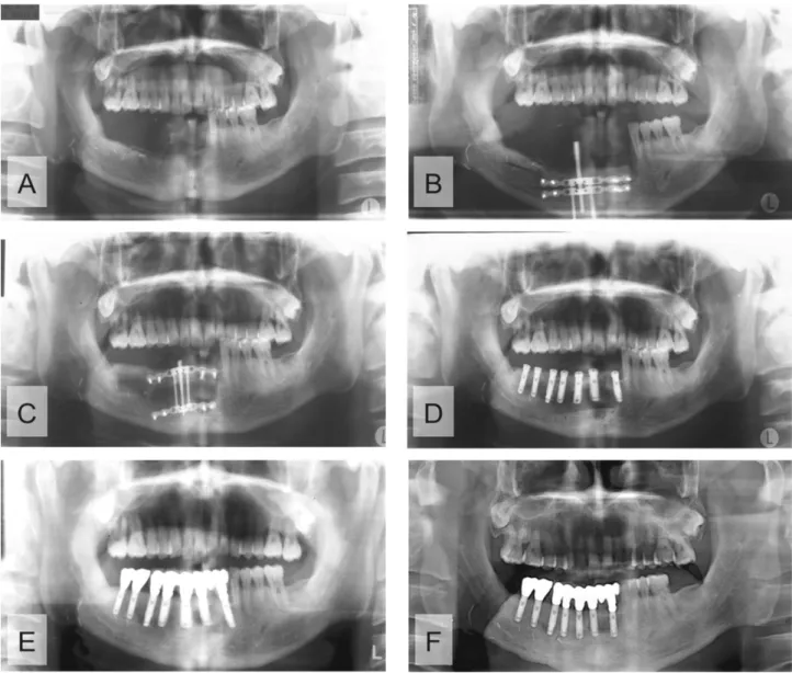 Fig. 1. Panoramic  radiographs  of  the  patient  who  underwent  alveolar  bone  distraction  osteogenesis  (ABDO)  after  marginal mandibulectomy
