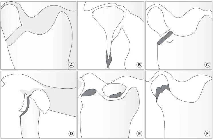 Fig. 3. Condylar fracture types according to modified Spiessel &amp; Schroll classification