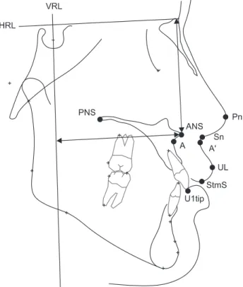 Fig. 1. Cephalometric landmarks and reference planes. (ANS: 