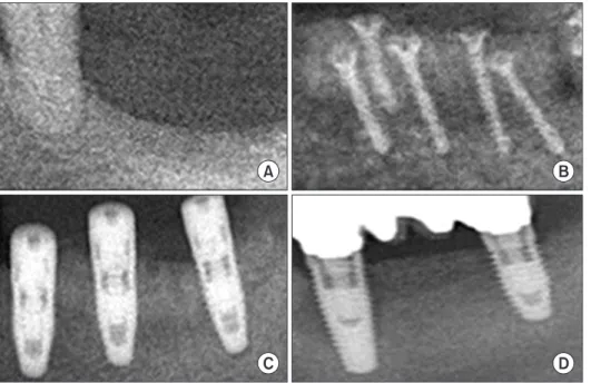 Fig. 1. Autogenous block bone graft,  implant  installation  and  functional  loading