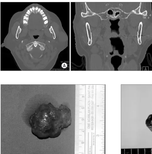 Fig. 3. Macroscopic view (external) shows well-circumscribed,  thinly encapsulated mass with soft consistency.