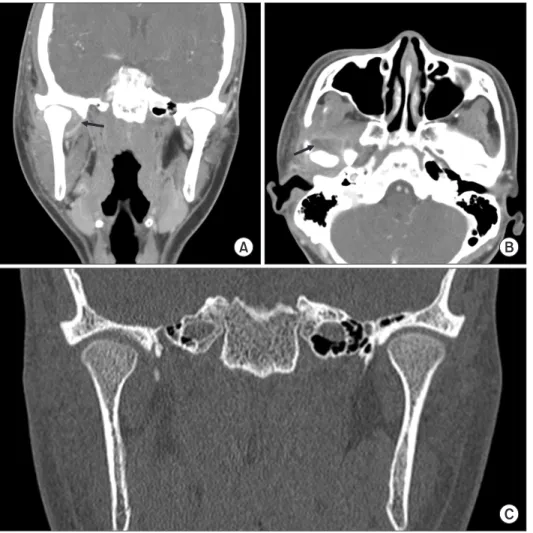 Fig. 2. A, B. Computed tomography (CT)  findings of Case 2. Diffuse inflammation  and  multifocal  small  abscess  cavity  around  right  temporomandibular  joint  (arrows)