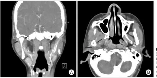 Fig.  3.  A,  B.  Computed  tomography  (CT) findings in Case 3. CT-scan reveals  a right masticator space abscess with a  low density mass (arrows).