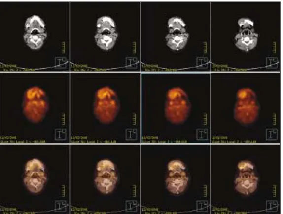 Fig. 5. A  slightly  imbalanced intake  of  FDG  was  found  on the right posterior mandibular area