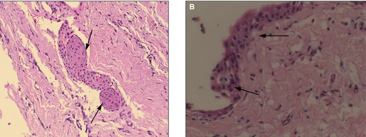 Fig. 3. A:  Histologic  section.(H&amp;E  staining,  original  magnification  x200)  This  histologic  section  showing  pseudo-glandular structure in connective tissue