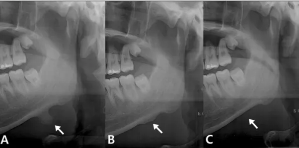 Fig. 3. The excised tumor was 10 mm in length and 13 mm in width, with a whitish smooth surface.
