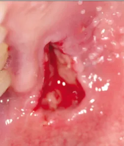 Fig. 12. The lesion regressed considerably, but small signal void is observed in central area of the lesion.