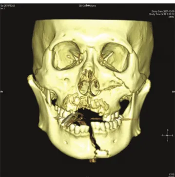 Fig. 1. Initial  3D-CT  view  of  mandibular  and  maxillary  com- com-pound fracture