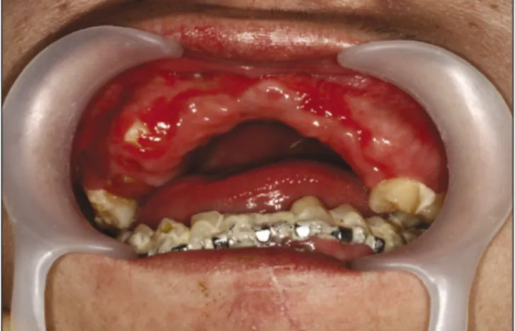 Fig. 5. Primary  rough  wound  closure  and  rubber  strips drainage view in the deep lacerated chin wounds.