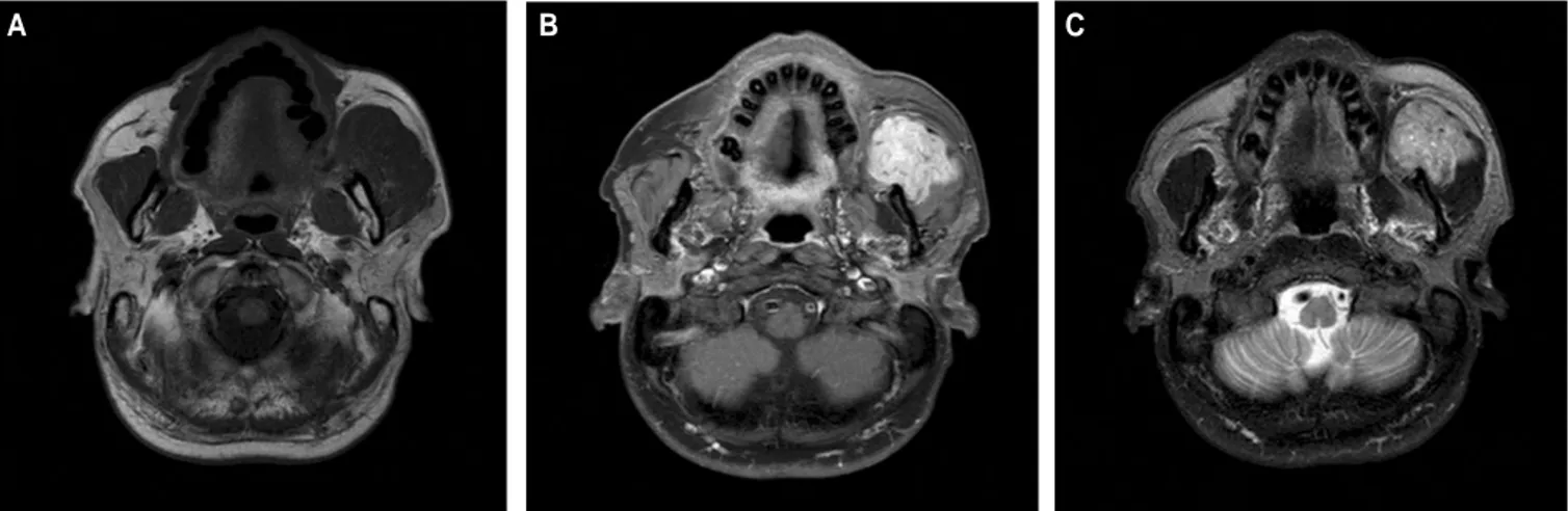 Fig. 2. Magnetic resonance imaging (MRI) of postoperative 3 months shows small residual lesion on anterior position of Lt.