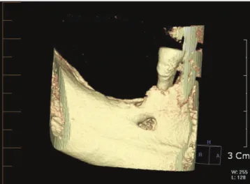 Fig. 3. Preoperative 3 dimensional view cone-beam comput- comput-erized  tomography  (CBCT)  scan  showing  the  right mandibular alveolar ridge.