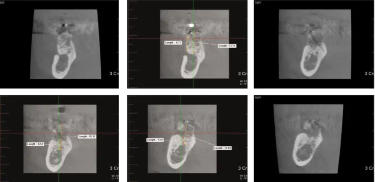 Fig. 12. Two  Implants  were  placed  with  more than 35 NCm torque on grafted sites with  trans-gingival type fixture