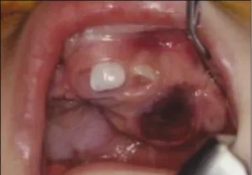 Fig. 2. Axial computed tomography (CT) of patient showing radiolucent lesion expanding into labial and palatal direction.