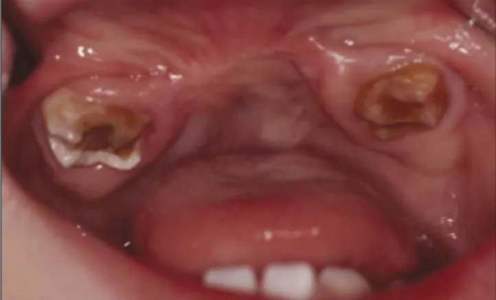 Fig. 5. Clinical  photograph  after  second  operation.  There was no recurrence.