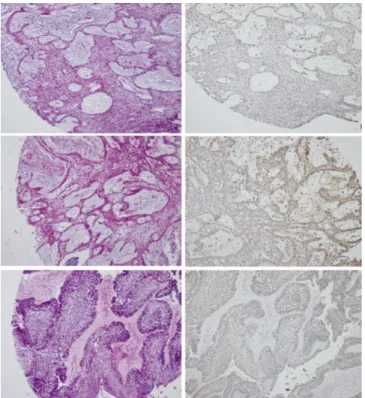 Fig. 6. Loss of E-cadherin expression in benign ameloblas- ameloblas-toma  without  recurrence  (1st  lane)  and  with  recurrence (2nd  lane),  and  in  carcinoma  ex-ameloblastoma  (3rd  and 4th lane).