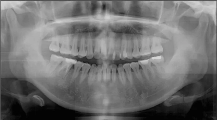 Fig. 2. The  initial  panoramic  view  showed  a  PDL  space widening of #46 and 47, haziness and mucosal thickening in the maxillary sinus, both.