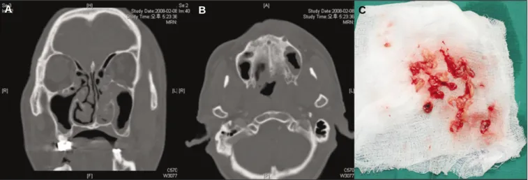 Fig. 5. A, B: CT showing mucosal thickening of Lt. maxillary and ethmoidal sinus, C: Surgical specimen.