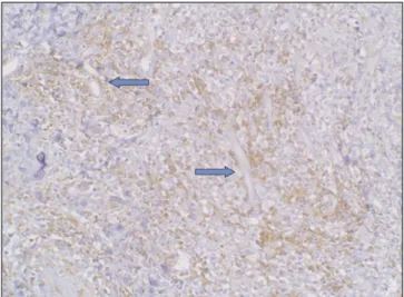 Fig. 9. TIA/Granzyme B expression in the extranodal NK/T- NK/T-cell lymphoma.(arrow marker: vessel, original magnification x200)