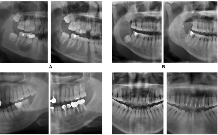 Fig. 1. Classification of bone healing on panoramic radiogra.