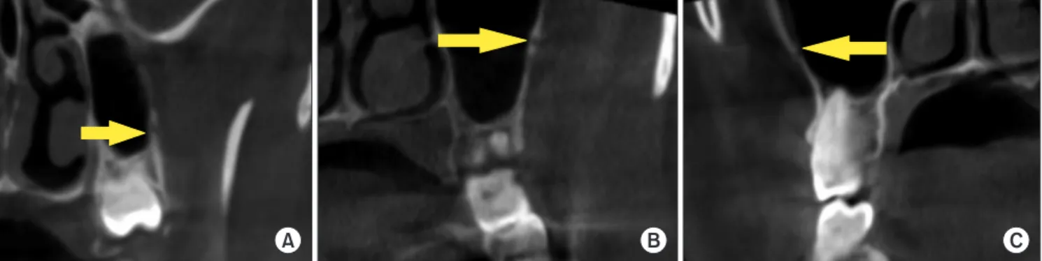 Fig. 4. Tomographic appearance of lateral antral intraosseous canals according to classification of Lee et al