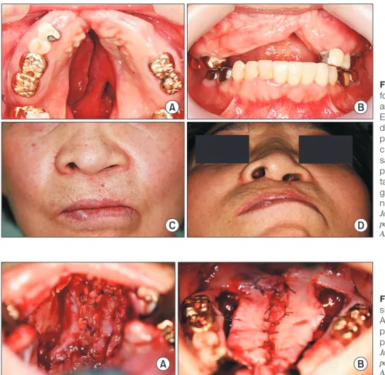 Fig. 1. Clinical features. Cleft nasal de- de-formity due to sequelae of the cleft lip  and palate