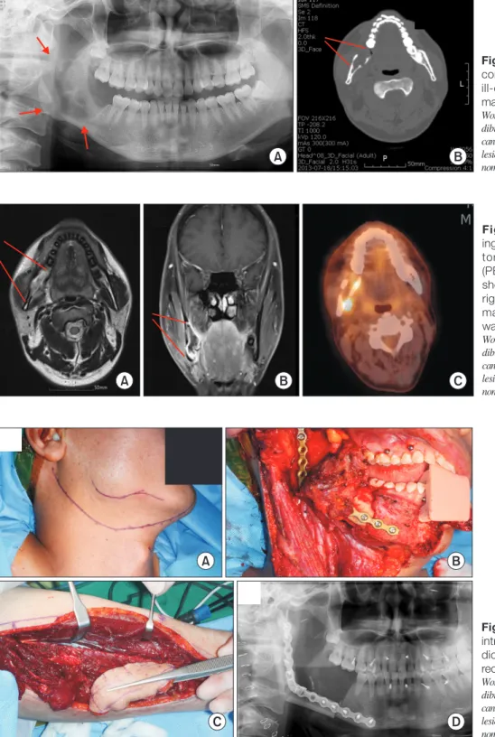 Fig. 1. Panoramic radiograph (A) and  computed tomography (B) showed an  ill-defined radiolucent lesion on right  mandible (arrows).