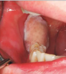 Fig. 4. Histological findings of Case 1 (H&amp;E staining). A. Hole view of the lesion (×20)