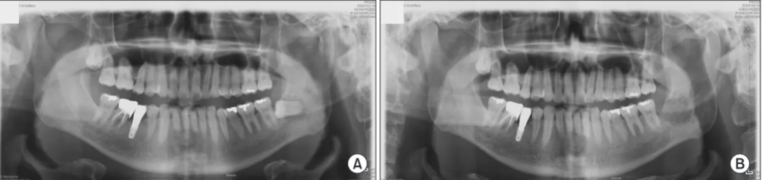Fig. 7. Magnetic resonance imaging (A- (A-C) and positron emission  tomography-computed tomography (PET-CT) (D)  images