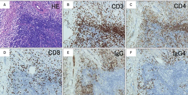 Fig. 2. Histopathological features of a submandibular gland affected by fibro-inflammation in an immunoglobulin G4-related dacryoadenitis  and sialoadeniti (IgG4-DS) patient
