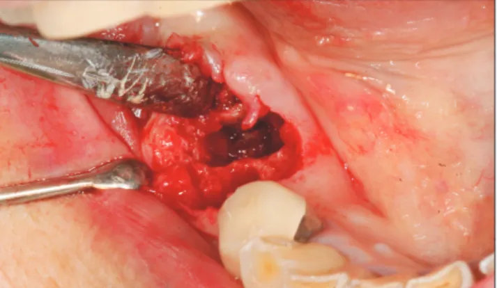 Fig. 1. E.g., Bony necrosis of the extraction socket immediately  following tooth extraction