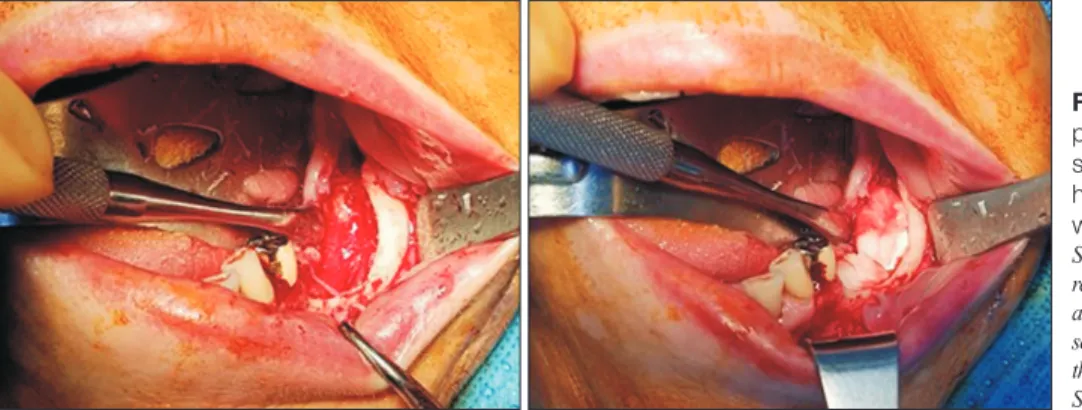 Fig. 1. Surgical procedure of ex- ex-perimental group. Absorbable collagen  sponge with absrobed recombinant  human bone morphogenetic protein-2  was applied to the bone defect.