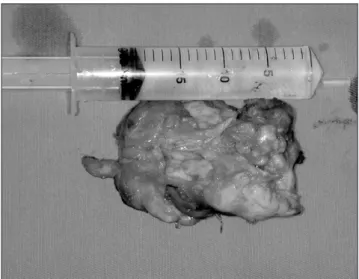 Fig. 2. Computed tomography scan  showing large tumoral mass.