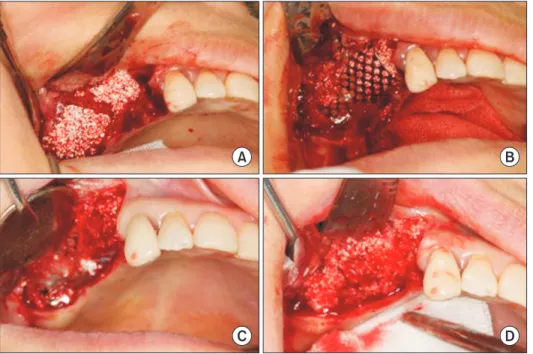 Fig. 1. Vertical ridge augmentation in a  53-year-old female. A. Allogenic and  al-loplastic bone substitutes were grafted