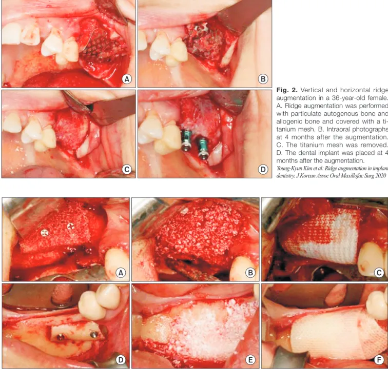 Fig. 2. Vertical and horizontal ridge  augmentation in a 36-year-old female. 